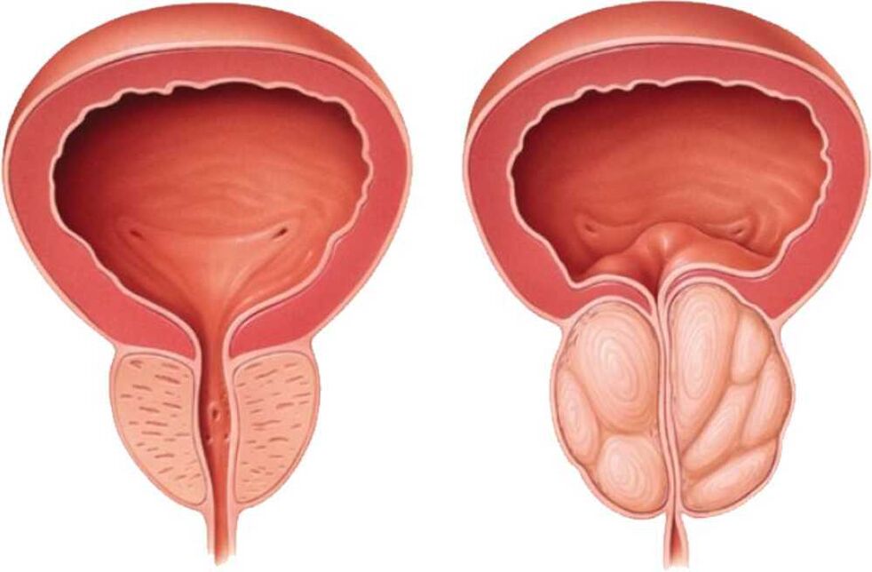 bolavá prostata