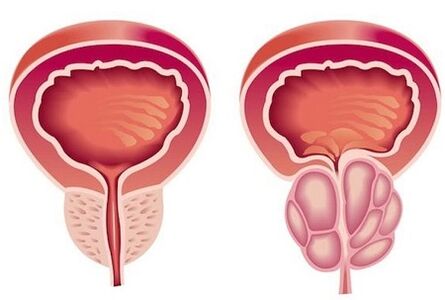 Příznaky prostatitidy u mužů